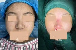 自体软骨隆鼻手术价格，自体软骨隆鼻有什么害处