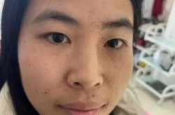 治疗太田痣需要多少钱，太田痣去除手术一般多少钱