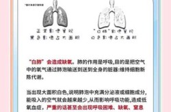 光咳嗽不高烧会变白肺吗，咳嗽不发烧会是肺炎吗