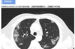 肺部病毒感染最坏结果，病毒性肺部感染