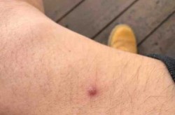 男性得了hpv有什么症状，男的得hpv会有症状吗