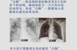 治疗白肺病哪个医院最好，白肺最好的三个医院