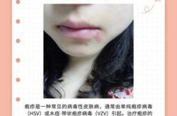 kp2病毒感染会传染吗，病毒性疱疹会传染吗