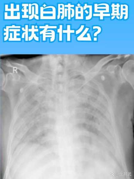 肺部有白斑是什么情况,肺上有白色斑点是什么病