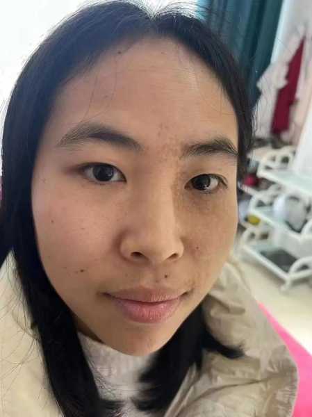 治疗太田痣需要多少钱,太田痣去除手术一般多少钱