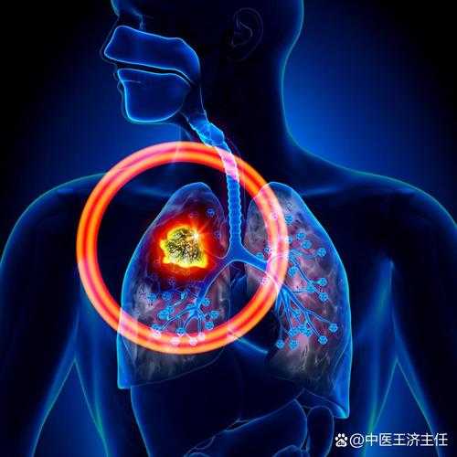 肺炎边缘模糊了要警惕了，肺炎治疗9天,边缘模糊了要警惕了