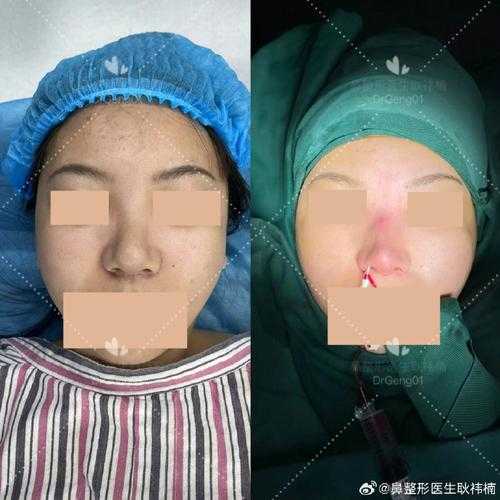 自体软骨隆鼻手术价格,自体软骨隆鼻有什么害处
