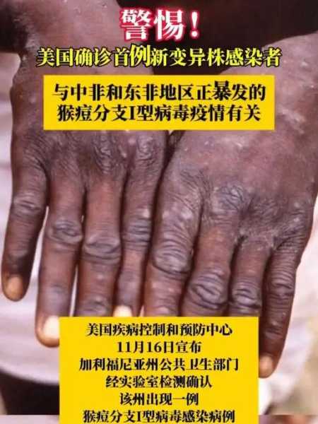 美国新病毒的最新消息，最新美国病毒感染
