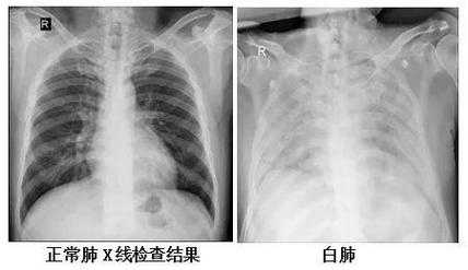 肺部两边发白是什么病，肺全部白了是什么病啊