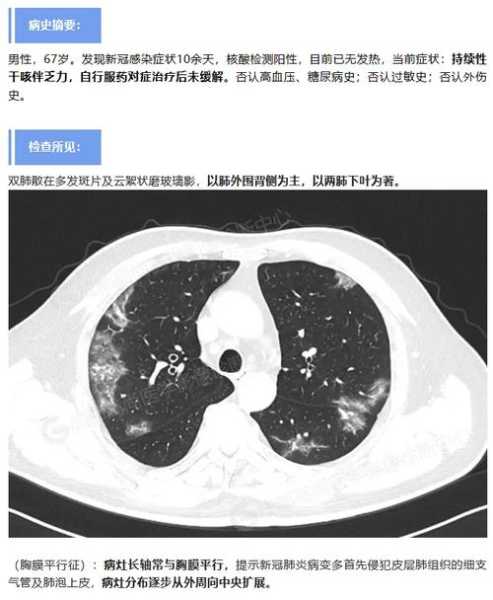 肺部病毒感染最坏结果，病毒性肺部感染