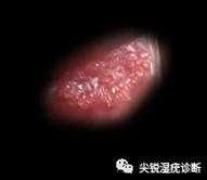 男的感染hpv什么症状，男性hpv症状有哪些