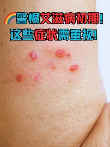 最新病毒症状初期表现,艾滋病毒初期感染症状