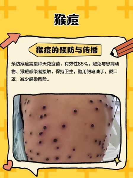 英国确认一例猴痘病例,第一例猴痘病例是在什么时候