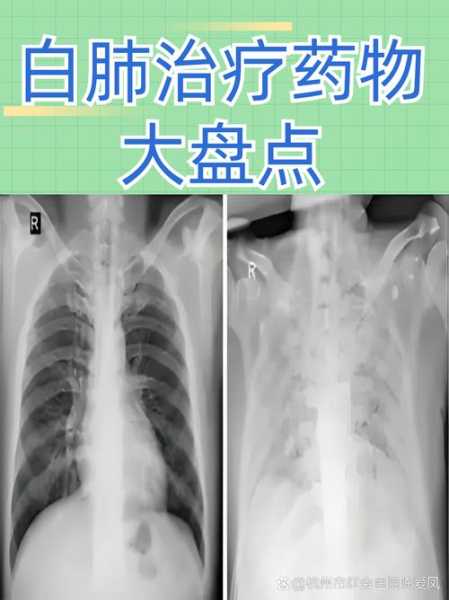 偏肺病毒感染的治疗方法,偏肺病毒用什么药治疗